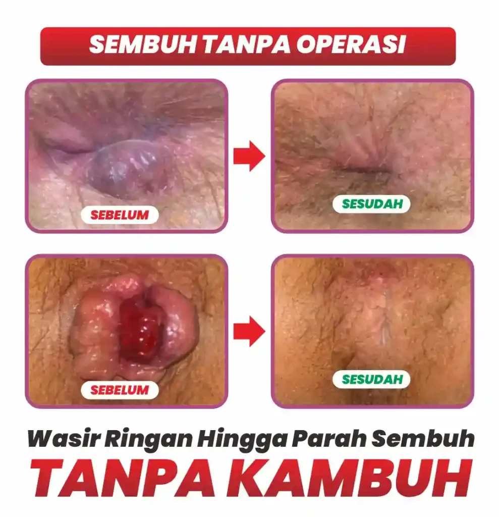 Ilustrasi Wasir